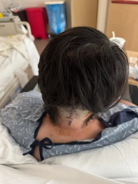 Derek Crosby Chiari Malformation recovery journey - post-op incision healing